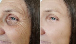 Microneedling Muenchen vorher-nachher