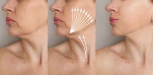 fadenlifting vorher nachher