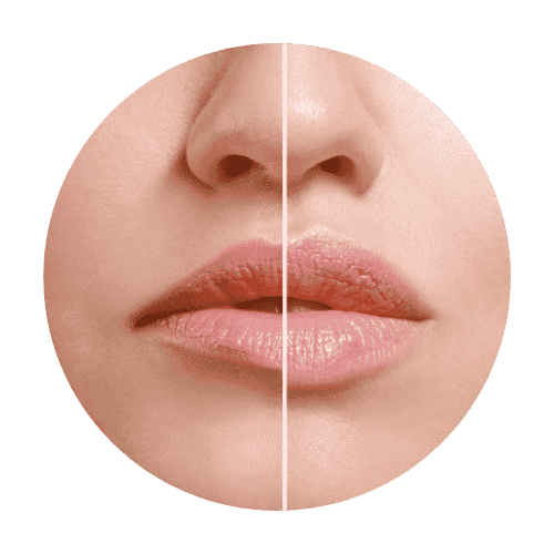 lippenaufspritzen muenchen