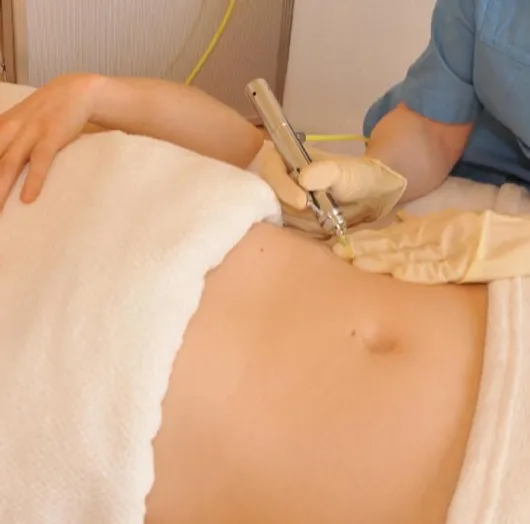 Carboxytherapie München