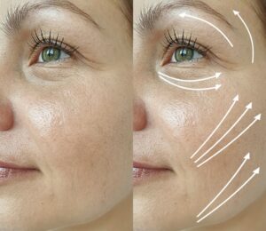 Fadenlifting München West